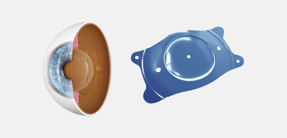 ICL人工晶體植入術(shù)